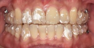 Read more about the article 인비절라인과 고정식 교정장치 비교