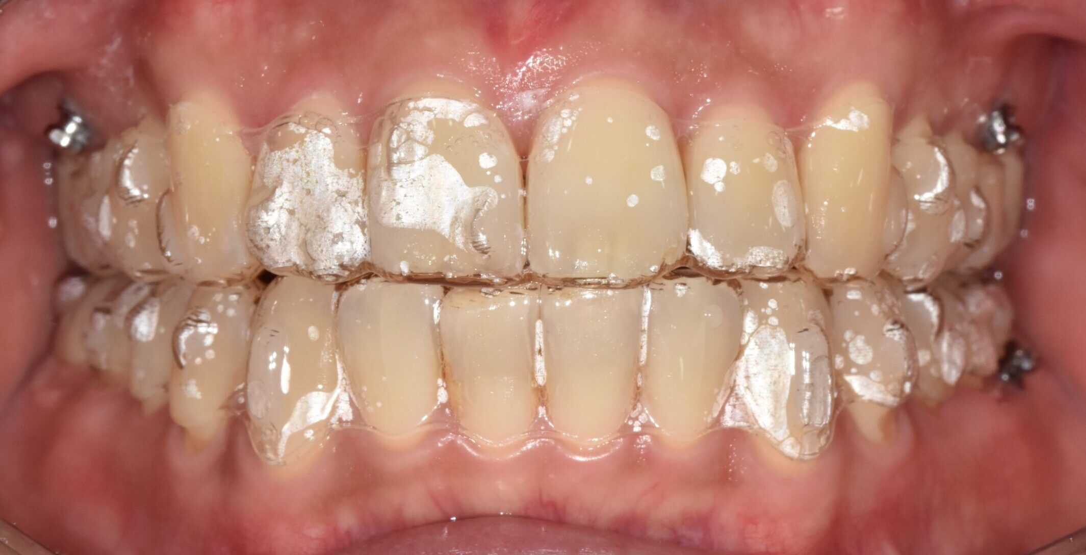 Read more about the article 인비절라인과 고정식 교정장치 비교