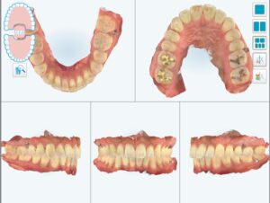 Read more about the article 교정 상담 첫날 하는일
