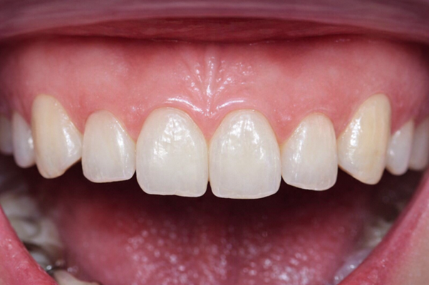 Read more about the article 성북구 교정과 전문의가 알려주는 유지장치 관리법