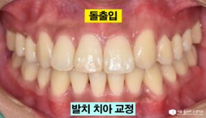 Read more about the article 서울 교정치과: 결손치와 돌출입 동시 해결법