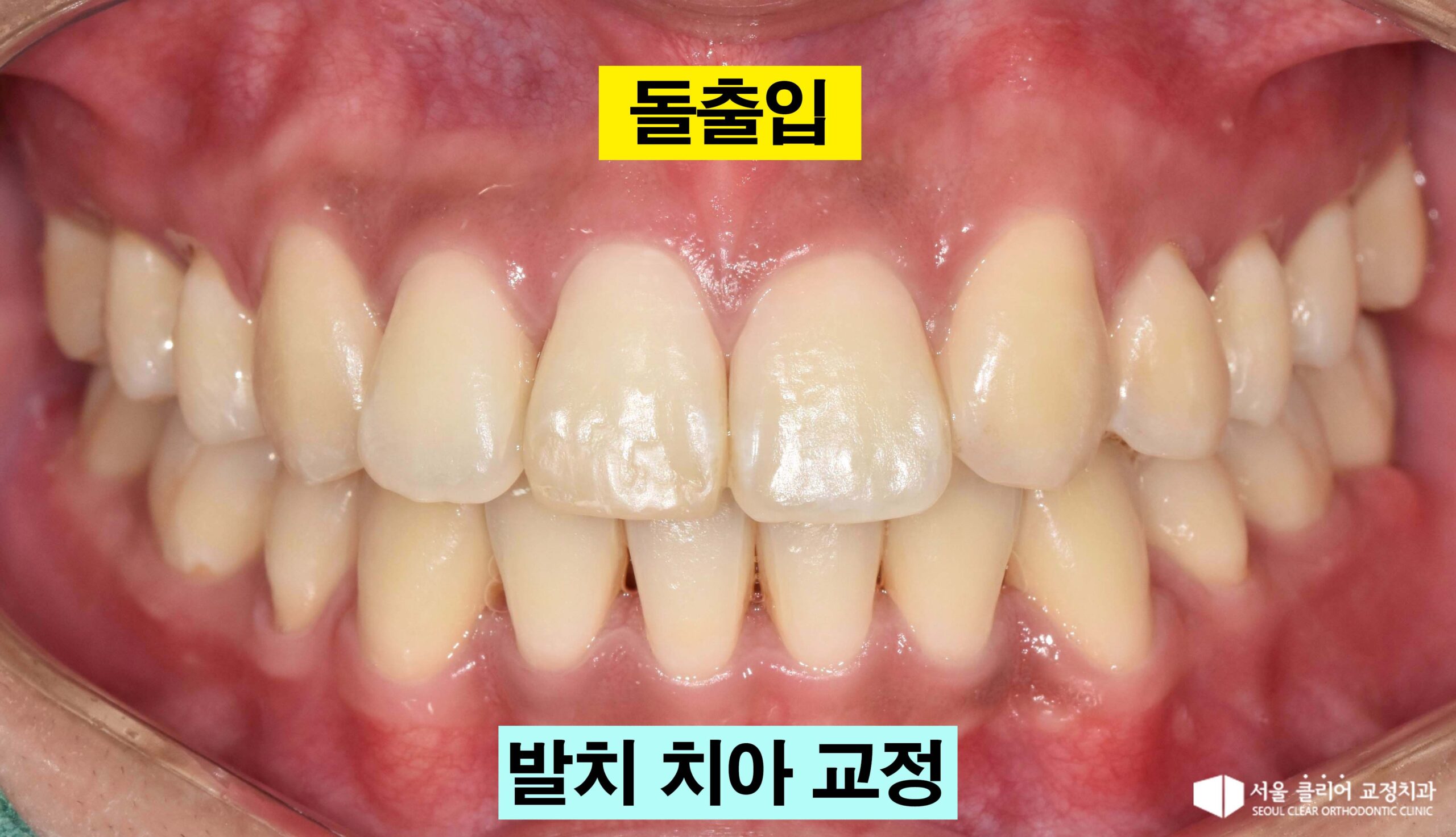 Read more about the article 서울 교정치과: 결손치와 돌출입 동시 해결법
