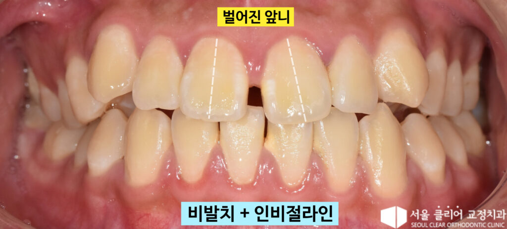 성북 교정치과 앞니 벌어짐 및 정중치아 벌어짐 치료 전 상태