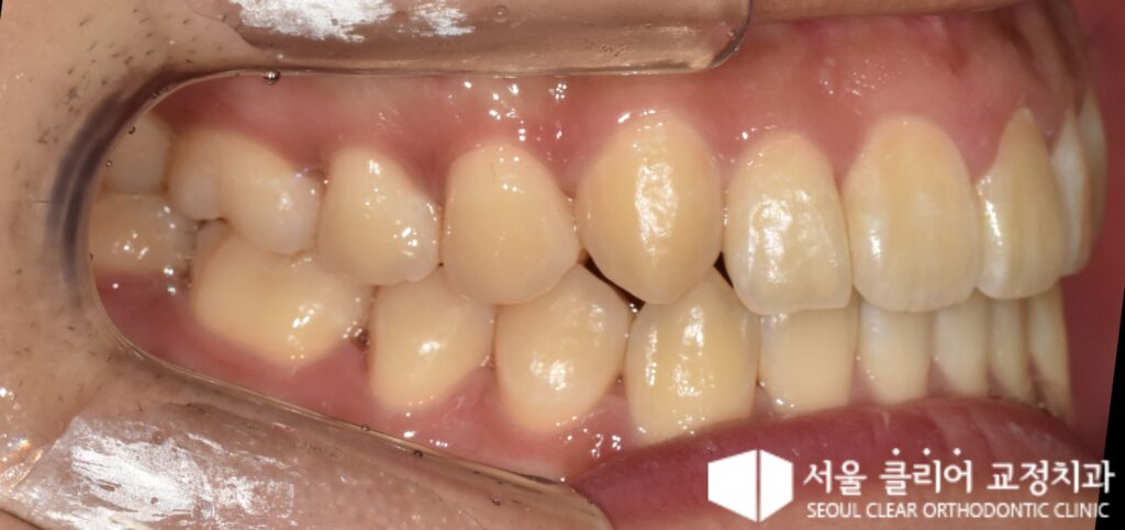 성북 교정치과 인비절라인 치료 완료 후 고른 치열과 정상 교합 관계 측면 오른쪽