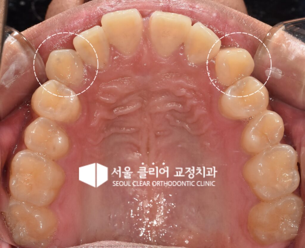 서울클리어교정치과 비발치 인비절라인 송곳니 덧니 배열 전 구강 사진