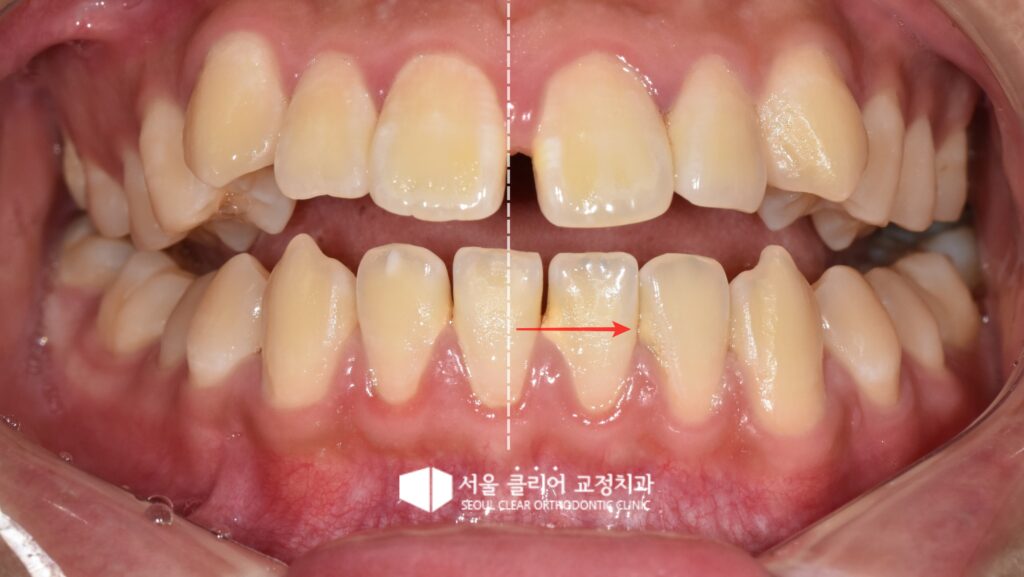 안면 비대칭으로 인한 아래 치열 정중선 불일치 및 부정교합 진단