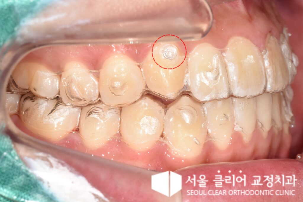 탄력 고무줄을 활용한 어금니 후방 이동 과정