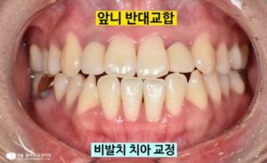 Read more about the article [길음동 교정치과] 비수술로 해결하는 반대교합, 거꾸로 물리는 치아 교정 사례