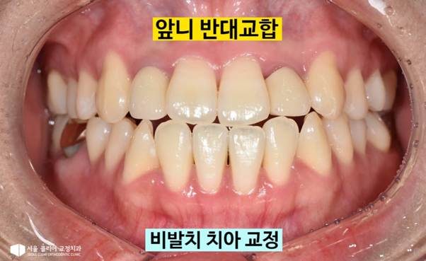 You are currently viewing [길음동 교정치과] 비수술로 해결하는 반대교합, 거꾸로 물리는 치아 교정 사례