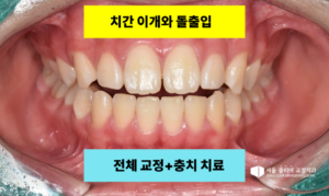 Read more about the article [정릉 교정치과] 입술이 안 다물어지는 돌출입, 발치 교정으로 편안하고 예쁜 미소 만들기