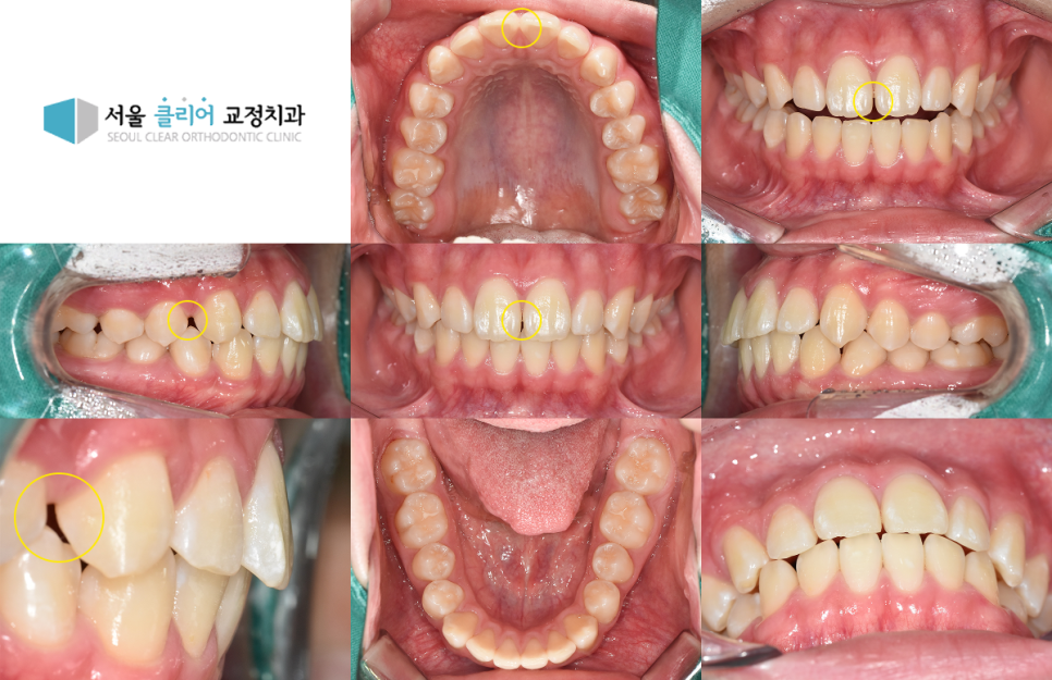 정릉 교정치과 입술이 잘 안 다물어지는 돌출입 치료 전 구강 내 사진