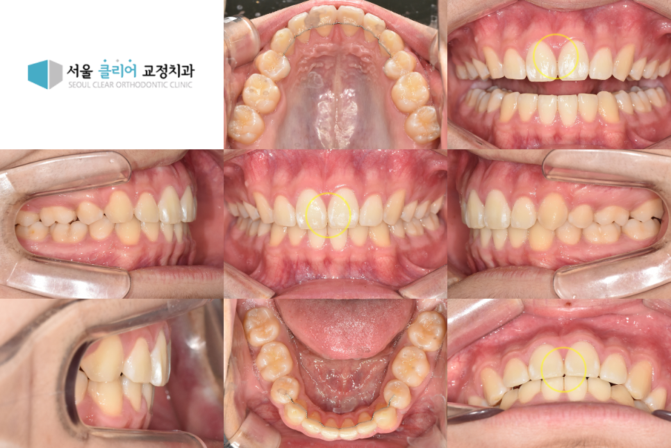 발치 교정 완료 후 가지런해진 치아 배열과 긴밀한 교합 상태
