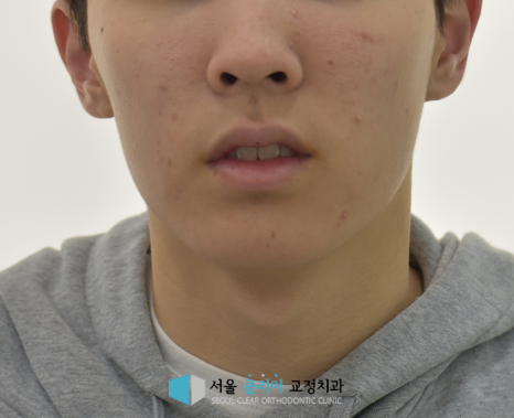 돌출입 교정 후 입술이 자연스럽게 다물어지고 세련되게 개선된 앞모습