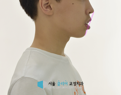 정릉 교정치과 입술이 잘 안 다물어지는 돌출입 치료 전 옆모습 사진
